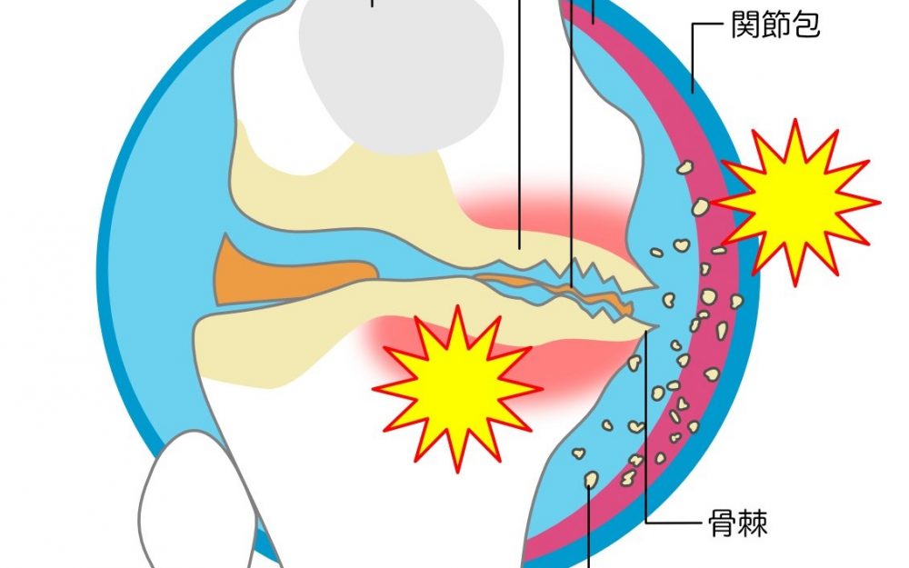 足の甲の骨棘の治療