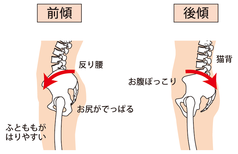 変形性膝関節症と反り腰、膝痛の仕組み
